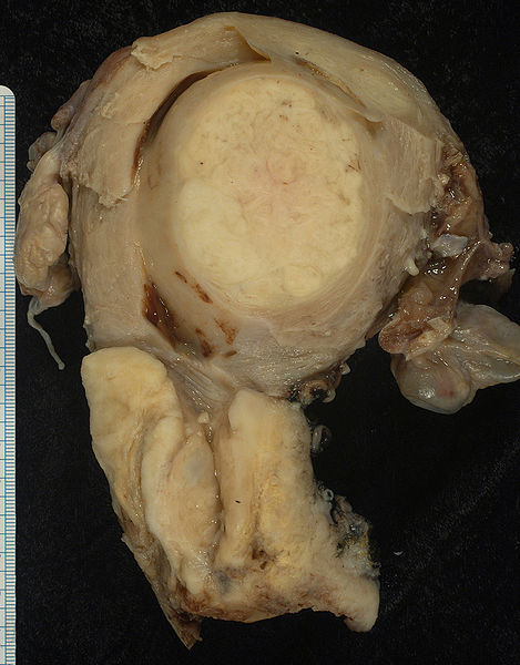469px Squamous carcinoma of the cervix